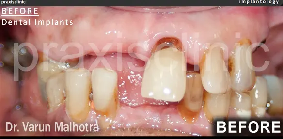 Multiple missing teeth in both the upper and lower jaw of a patient. Full Mouth Rehabilitation planned to replaced with a multiple dental implants at Praxis Dental Clinic, Mumbai, India by Dr Varun Malhotra, Top Dental 
                            Implant surgeon of Mumbai, India 